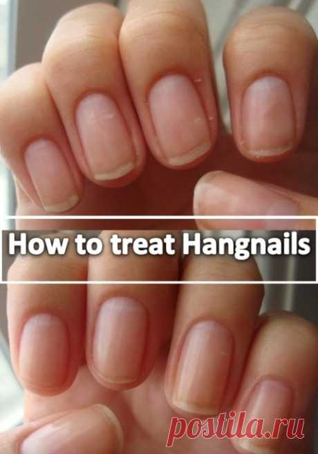 Home Remedies for Hangnails | Virtual Clinic