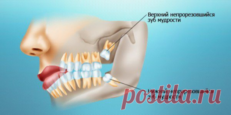 «За» и «против». Удалять ли зубы мудрости? - В здоровом теле — здоровый дух