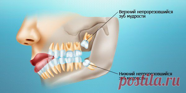 «За» и «против». Удалять ли зубы мудрости? - В здоровом теле — здоровый дух
