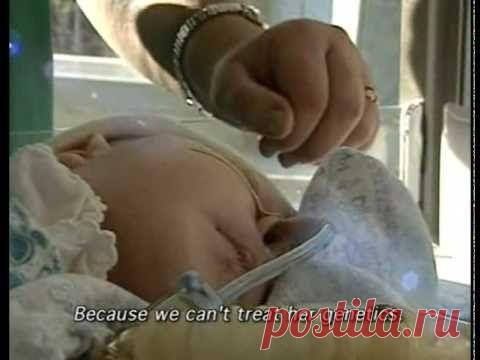 cernobil. Дети мутанты. Слабонервным не смотреть !!! часть 2