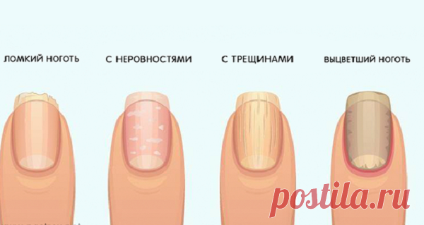 Предупреждающие признаки ваших ногтей о вашем здоровье