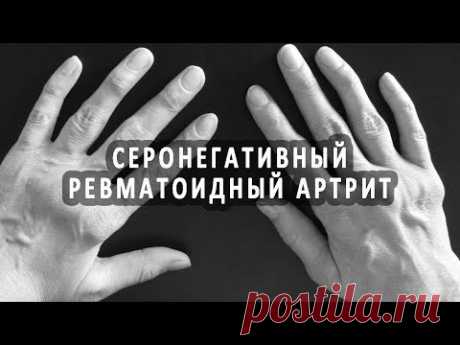 Что такое серонегативный ревматоидный артрит?