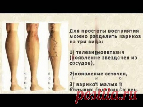 Варикоз Упражнения для лечения