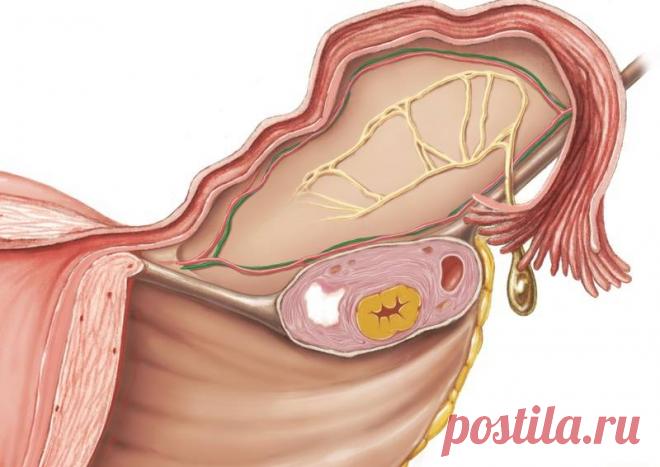 Женщины игнорируют их, а врачи часто неправильно диагностируют эти ПЕРВЫЕ ДВА СИМПТОМА РАКА ЯИЧНИКОВ