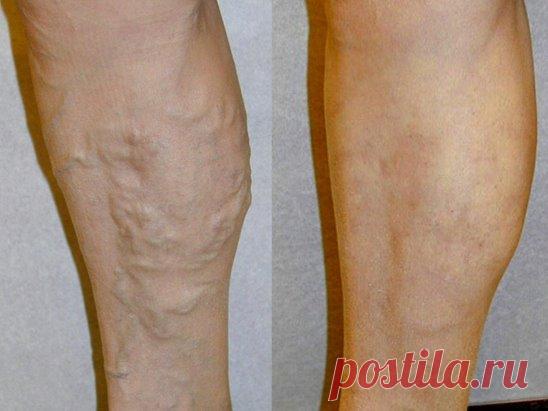 ПОПРОБУЙТЕ ЭТУ СМЕСЬ — И ИЗБАВИТЕСЬ ОТ БОЛИ, 
ОТ КОТОРОЙ СТРАДАЛИ МНОГО ЛЕТ
Если вы страдаете от хронических болей, то это не значит, что единственный способ облегчить их — покупать обезболивающие в аптеках. Есть методы и эффективнее! Только врачи вам о них не рассказывают, потому что проще и безопаснее порекомендовать аптечный препарат. С продаж которого, кстати, можно еще и получить «откат»!
Вот классический народный французский рецепт избавления от хронических болей.
Вам нужно смешать нераф