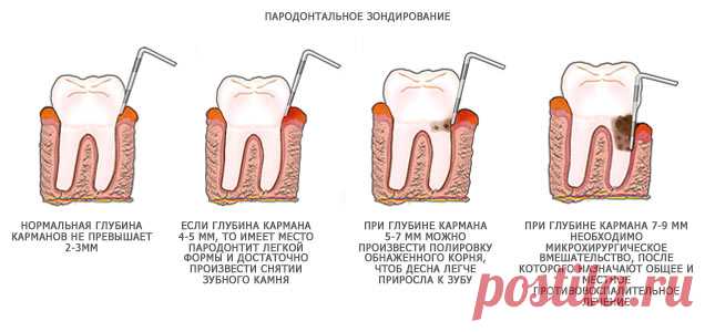 Пародонтоз. Причины, симптомы, лечение. Можно ли вылечить в домашних условиях?