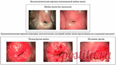Псевдоэрозия шейки матки: причины, диагностика, лечение