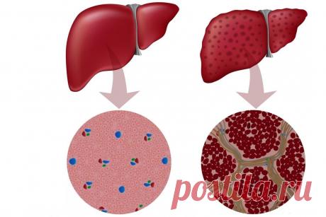 Киста печени. Причины, симптомы и осложнения кист печени