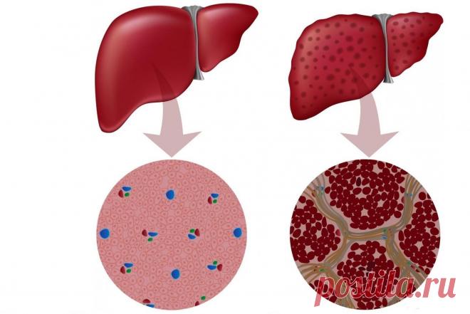 Киста печени. Причины, симптомы и осложнения кист печени