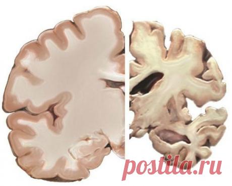 Картинка дня. Мозг здоровый и мозг с «Альцгеймером» — Нейроновости