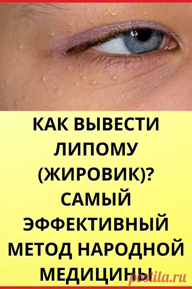 КАК ВЫВЕСТИ ЛИПОМУ (ЖИРОВИК)? САМЫЙ ЭФФЕКТИВНЫЙ МЕТОД НАРОДНОЙ МЕДИЦИНЫ
