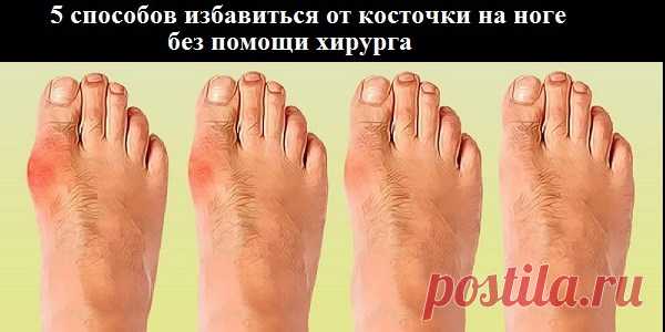 5 СПОСОБОВ ИЗБАВИТЬСЯ ОТ КОСТОЧКИ НА НОГЕ БЕЗ ПОМОЩИ ХИРУРГА — Копилочка полезных советов