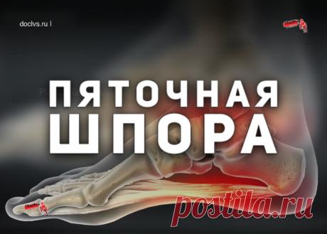 Одна из таких болезней не понаслышке известна многим - пяточная шпора, как ее называют в народе.
