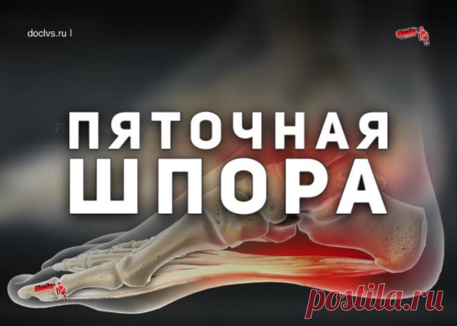 Одна из таких болезней не понаслышке известна многим - пяточная шпора, как ее называют в народе.