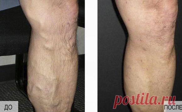 Лечение варикоза народными средствами