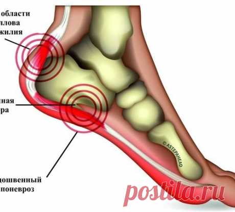 Эффективное лечение пяточной шпоры