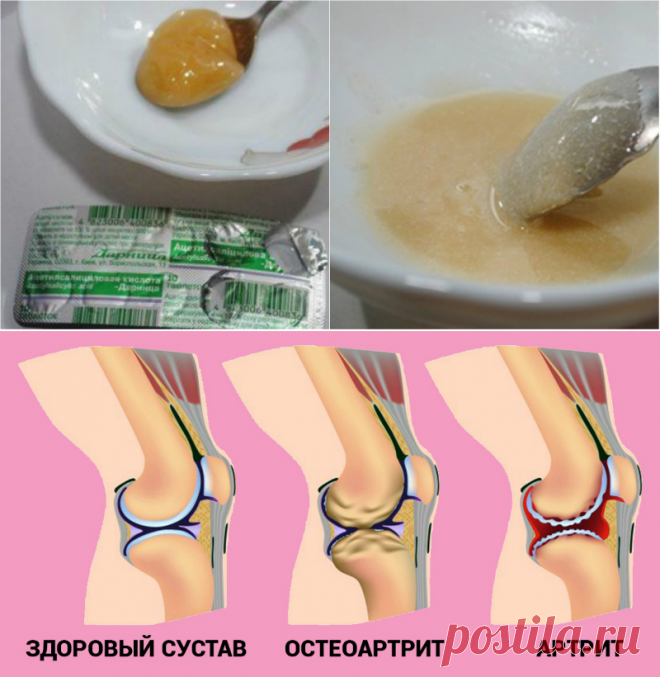 Подруга потратила две зарплаты, чтобы вылечить колени. Лишь это простое средство остановило артроз!