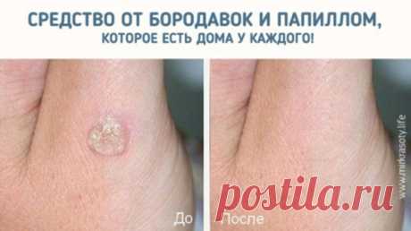 Через 5 дней от папиллом и бородавок не останется и следа… — Полезные советы