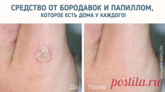 Через 5 дней от папиллом и бородавок не останется и следа… — Полезные советы