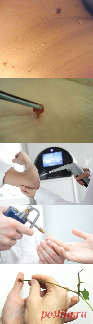 Бородавки на теле- причины их появления. — Всегда в форме!