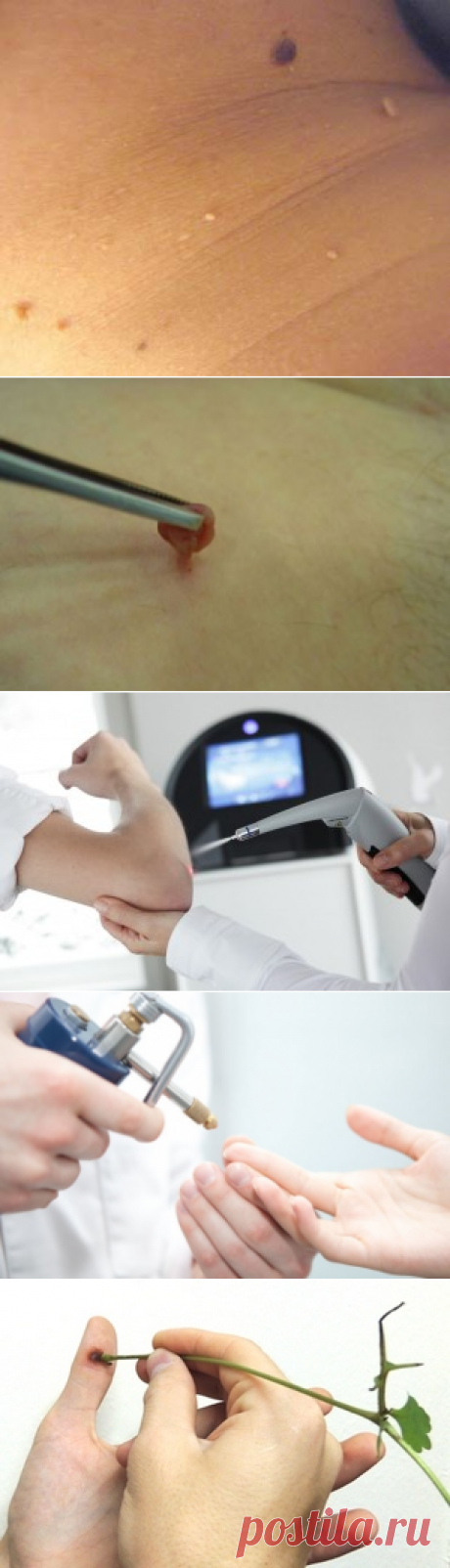 Бородавки на теле- причины их появления. — Всегда в форме!