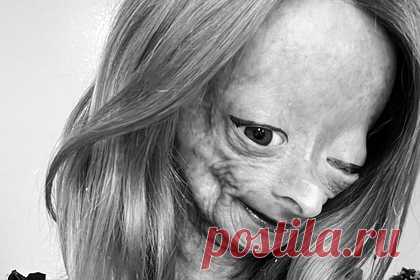 Звезда YouTube с редкой болезнью умерла в 15 лет. Блогерша Адалия Роуз (Adalia Rose), ставшая звездой YouTube благодаря своей необычной внешности, умерла от редкого заболевания в возрасте 15 лет. Подросток из Техаса страдала детской прогерией или синдромом Хатчинсона — Гилфорда, который известен как «болезнь Бенджамина Баттона».