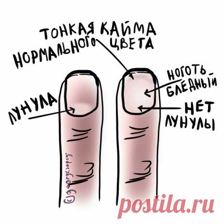 Отсутствие лунулы на ногтях | Для пациентов | Яндекс Дзен