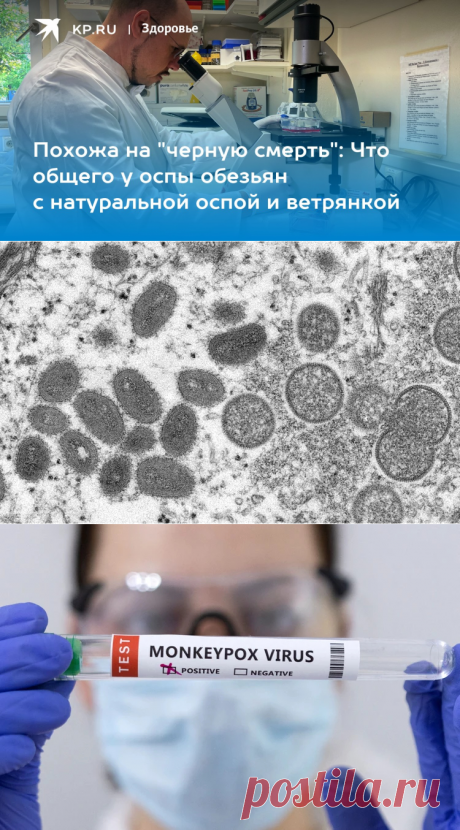 26-5-22-Похожа на "черную смерть": Что общего у оспы обезьян с натуральной оспой и ветрянкой - KP.Ru