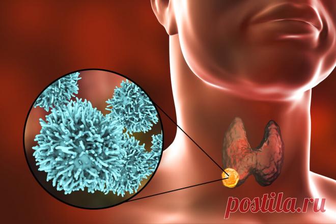 Рак щитовидной железы: очевидные признаки
Щитовидная железа располагается у основания шеи человека и играет важную роль в его организме. Одни из основных функций этого органа: — участие в регулировании сердечного ритма; — контроль за AD. И сбои в работе щитовидки сказываются на здоровье самым негативным образом. А еще щитовидная железа подвержена новообразованиям, в том числе злокачественным. Как же достоверно определить […]
Читай дальше на сайте. Жми подробнее ➡