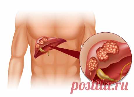 Фиброз печени. Что это такое, откуда берётся и когда переходит в цирроз