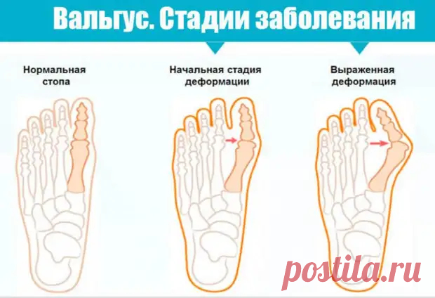 Почему происходит вальгусная деформация стопы - Народная медицина - медиаплатформа МирТесен