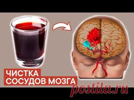 ЧИСТКА СОСУДОВ МОЗГА с помощью... Что засоряет сосуды мозга?