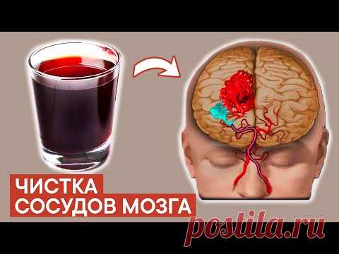 ЧИСТКА СОСУДОВ МОЗГА с помощью... Что засоряет сосуды мозга?