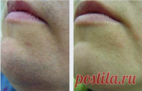 Смотрите и Удивляйтесь! Древний русский рецепт поможет избавиться от волос навсегда! Знаете ли вы, что существует решение главной проблемы женщин у которых есть нежелательная растительность на лице?