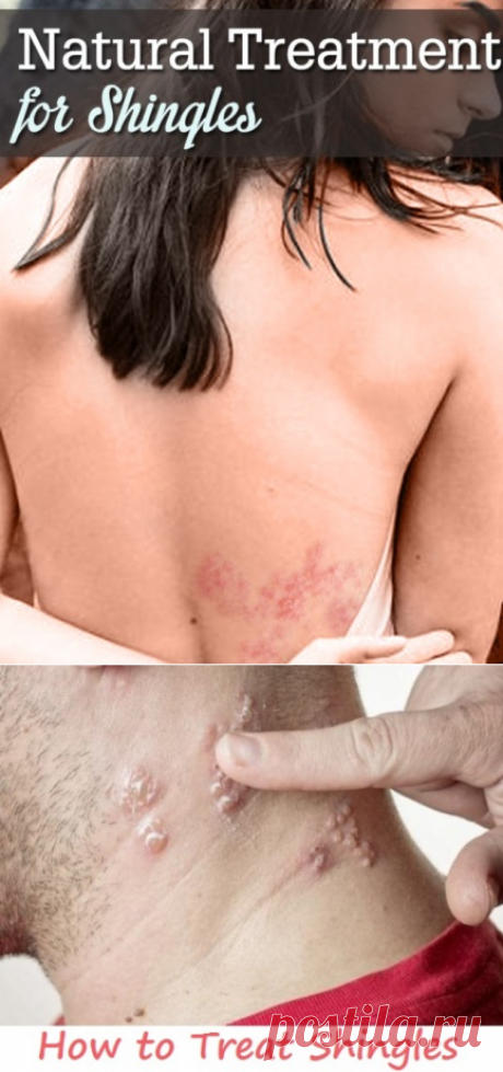 Home Remedies for Shingles | Virtual Clinic