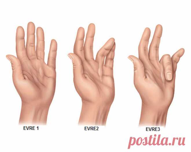 : Потяните себя за указательный палец 20 секунд. : Потяните себя за указательный палец 20 секунд. 
 
Существует целая наука, которая называется рефлексология и изучает биоактивные точки, расположенные на ладони (так же, как на стопе и на ухе) и управляющие всем организмом. 


Большой палец: беспокойство, головные боли, Большой палец, словно якорь, несет ответственность за все решения. Он тесно связан с эмоциями человека, а именно с беспокойством, депрессией, повышенной тре...