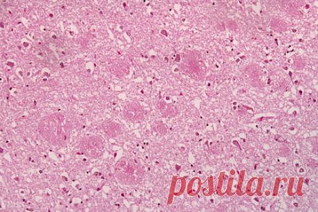 Болезнь Альцгеймера связали с влиянием окружающей среды. Ученые Университета Южного Уэльса впервые выяснили, какой вклад в развитие болезни Альцгеймера вносят гены и окружающая среда. Для этого исследователи изучили однояйцевых и дизиготных близнецов, определяя накопление амилоидных бляшек в мозге пациентов с помощью позитрон-эмиссионной томографии.