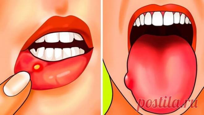 Дефицит фолиевой кислоты. 5 причин и 12 симптомов! | Тысяча и одна идея Вы часто чувствуете усталость или страдаете от язвенной болезни? Вы, вероятно, страдаете от дефицита фолиевой кислоты… Фолиевая кислота: витамин B9 является водорастворимым витамином, то есть не храниться в организме. В результате есть постоянная потребность в источниках питания, богатых этим веществом.