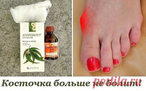 Косточка больше не болит! Потратила мелкие деньги на 2 средства, эффект невероятен. Помню, как ...