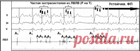 Фибрилляция предсердий - Доказательная медицина для всех