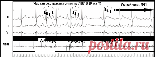 Фибрилляция предсердий - Доказательная медицина для всех