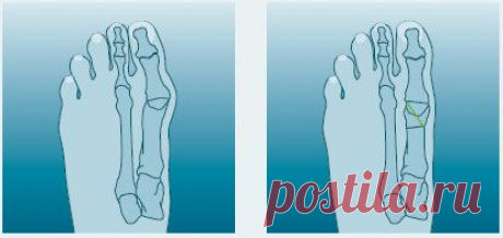 Hallux Valgus