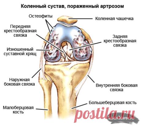 Лечение артроза коленного сустава народными средствами: лучшие рецепты