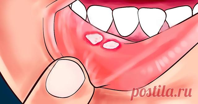 Стоматит можно вылечить всего за несколько минут, не используя никаких медикаментов
Одна из наиболее распространенных проблем нашей ротовой полости – это стоматит, который...
Читай пост далее на сайте. Жми ⏫ссылку выше