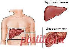 Заболевание печени