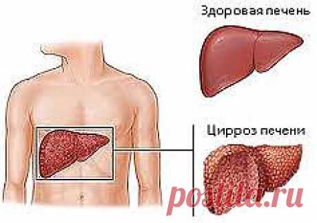 Заболевание печени