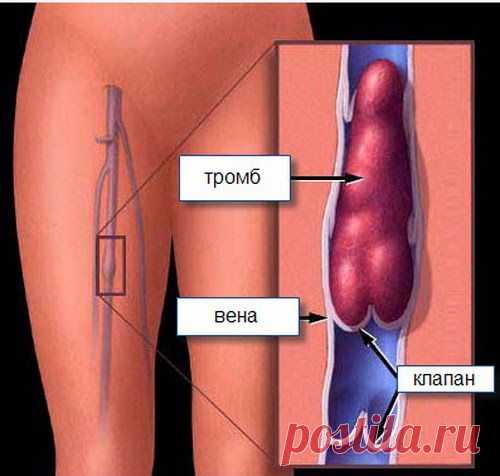 Рецепты от гипертонии и тромбофлебита | Друг пенсионера