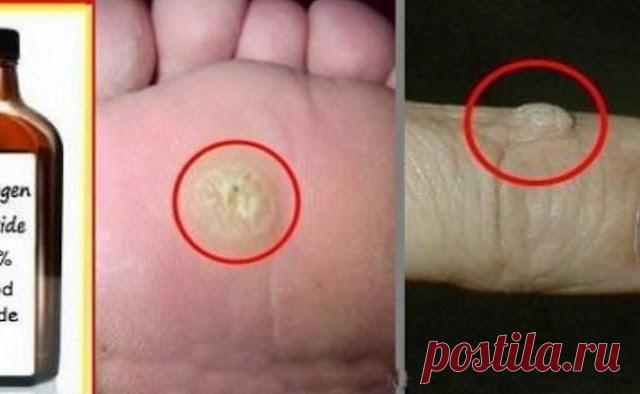 Как легко удалить бородавки с помощью перекиси водорода Легко и просто!   Любому, у кого есть бородавки на коже, хорошо известно, что они действительно распространены, но трудно устранить эту проблему. Тем не менее, они мо�…