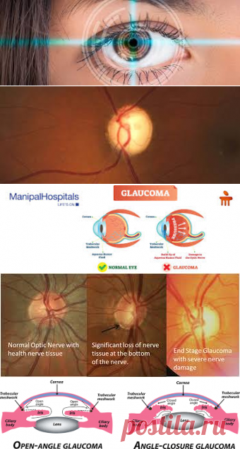 Glaucoma – Google Поиск