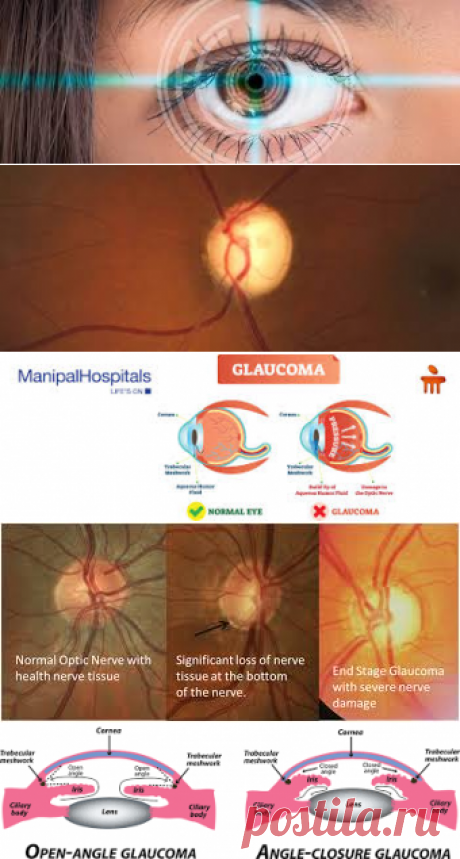 Glaucoma – Google Поиск